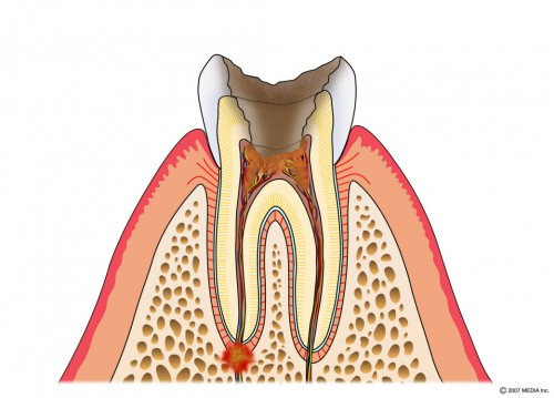 むし歯の進行　C4